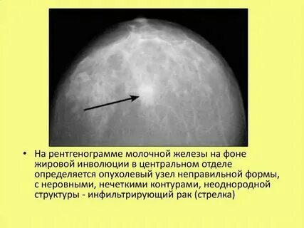 Что такое признаки жировой инволюции. Что такое признаки жировой инволюции
