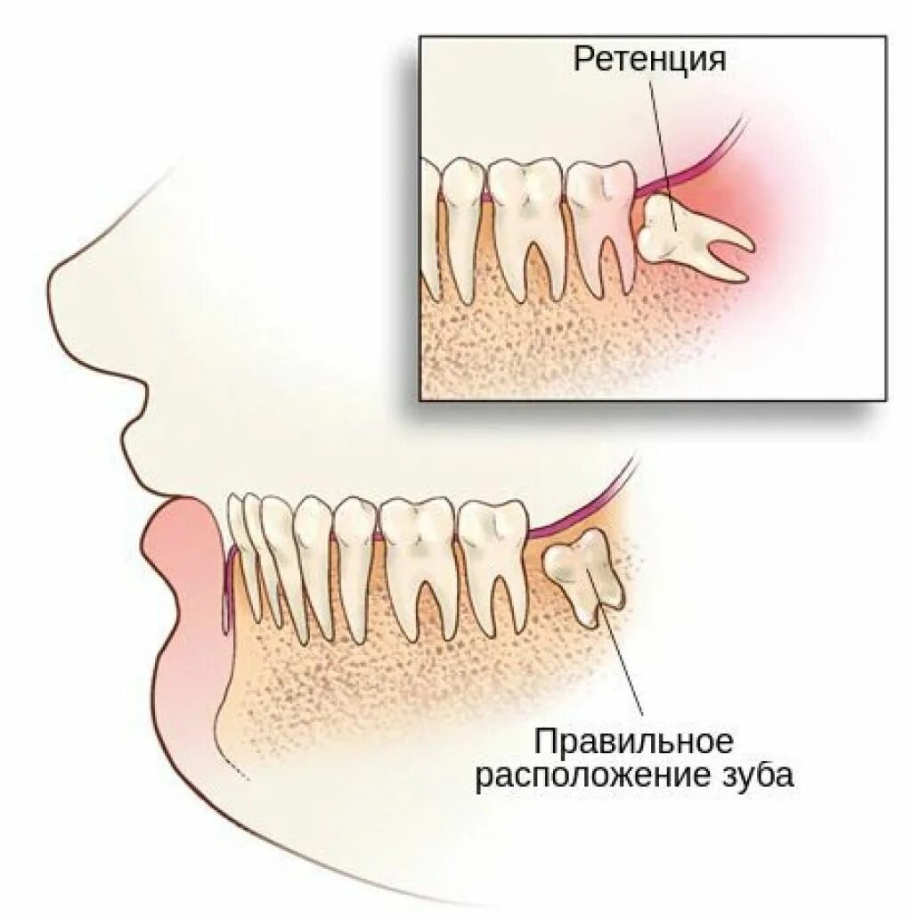 Ретинированный дистопированный зуб мудрости. Ретинированного дистопированного зуба мудрости. Дистопированный зуб мудрости Нижний. Зуб мудрости (3-й моляр, восьмерка). Сколько зубов мудрости может быть у человека