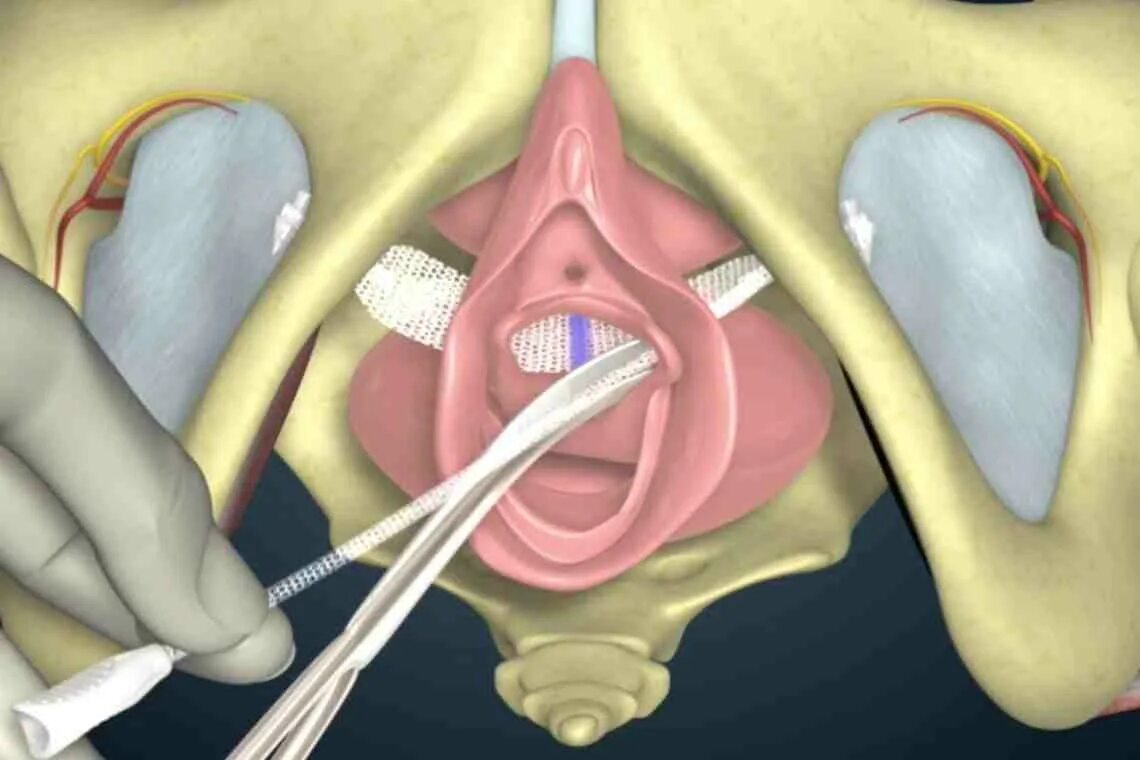 Катетер бартолиновой железы. Слинговая уретропексия. TVT петля при недержании. Уретропексия свободной синтетической петлёй.