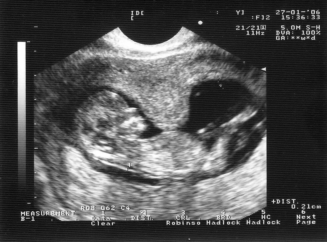 38 первый беременность. Гипертонус матки при беременности 2 триместр УЗИ. Тонус матки при беременности 1 триместр УЗИ. Гипертонус стенки матки при беременности 12 недель. Гипертонус матки на УЗИ при беременности.