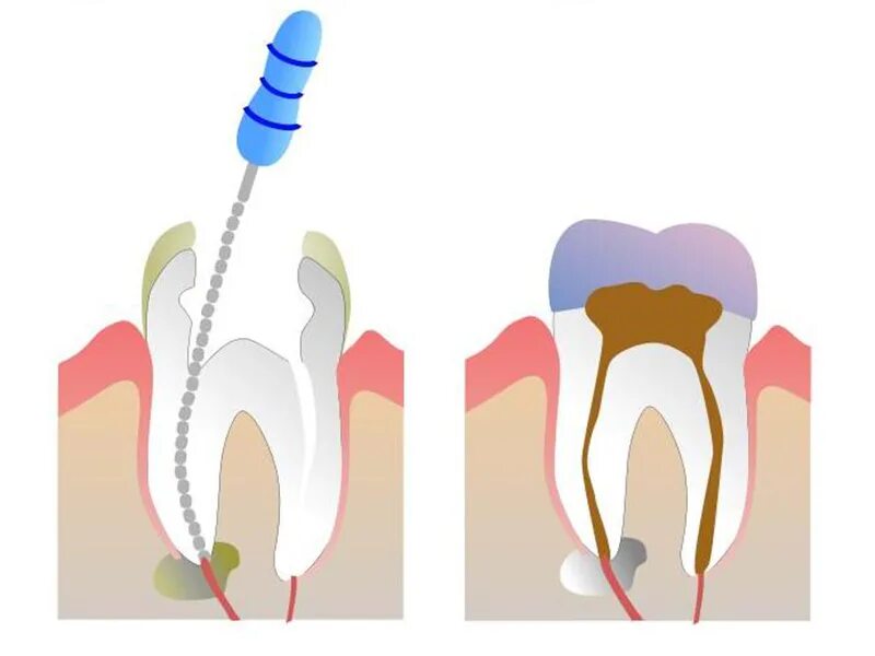 Удалили 8 зуб снизу мудрости. Удалить зуб метро. Еде к зубному. Пульпит пломбировка каналов. Позадимолярный периостит на рентгене.