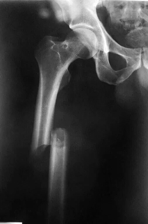 Трещина тазобедренного. Перелом бедренной кости рентген. Винтообразный перелом бедренной кости рентген. Перелом диафиза бедра рентген. Перелом средней трети правой бедренной кости.