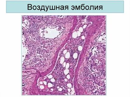 Воздушная эмболия
