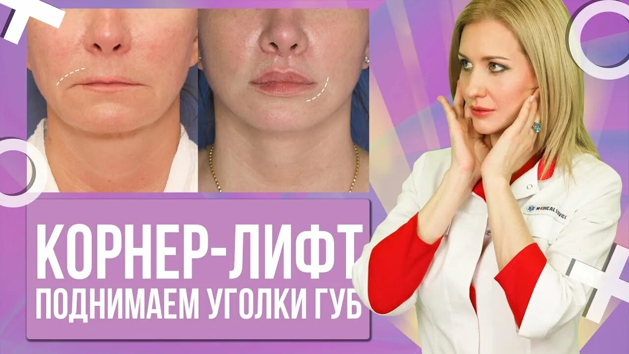 Отзыв о Операция по коррекции форм губ Хейлопластика по Киссельрингу Верхняя губ