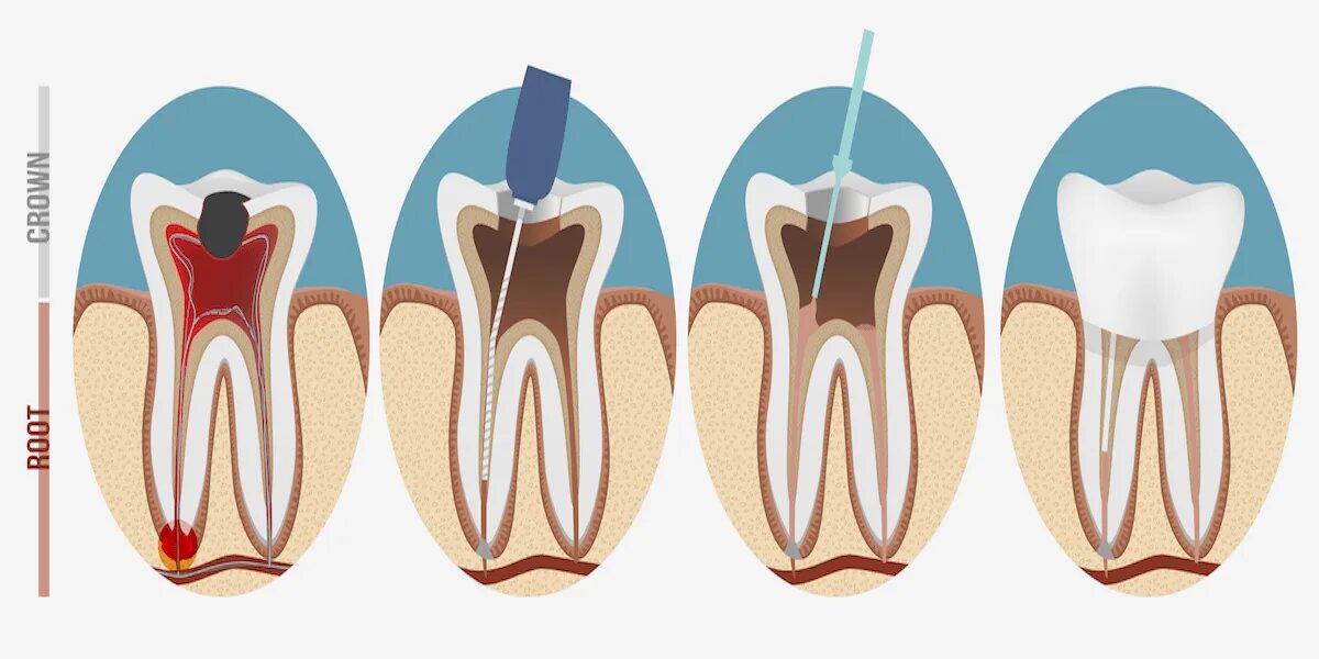 Через сколько зуб перестает болеть. Пломбирование канала зуба. Пломбирование каналов зубов.