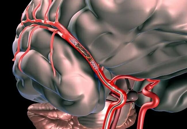 Стентирование аневризмы. Стентирование аневризмы головного мозга. Стент в артерии головного мозга. Стент для сосудов головного мозга.