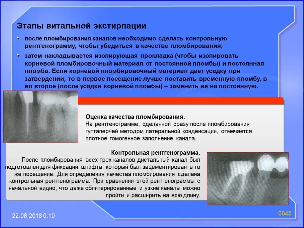 Постоянное пломбирование корневого канала