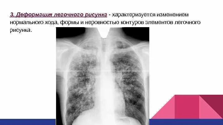 Описание рентгенограммы легких. Линейный фиброз рентген. Очаги уплотнения легочной ткани. Заключение по рентгенограмме органов грудной клетки. Рентген корни лёгких.