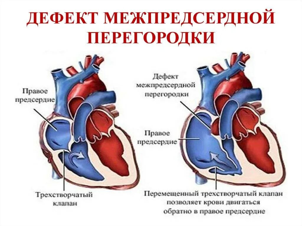 Окно в сердце у ребенка. Врожденный порок сердца ДМПП. Врожденный порок сердца дефект межпредсердной перегородки. ВПС дефект межпредсердной перегородки. Врожденные пороки сердца у детей дефект межпредсердной перегородки.