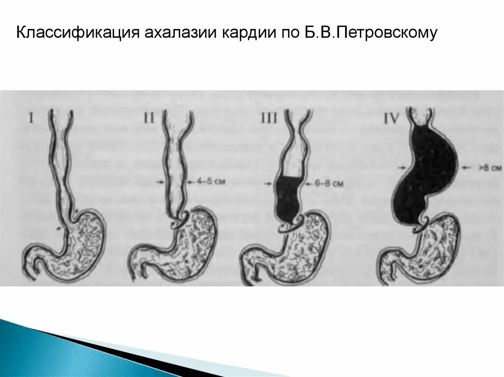 Халазия пищевода. Ахалазия кардиальной части пищевода. Ахалазия пищевода 1 степени. Ахалазия пищевода на рентгенограмме.