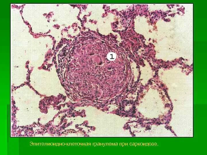 Эпителиоидноклеточные гранулемы. Эпителиоидные клетки гранулемы. Морфология саркоидной гранулемы. Эпителиоидно-клеточная гранулема при саркоидозе. Саркоидная гранулема