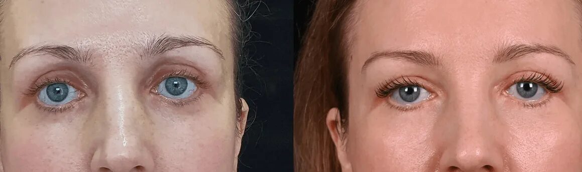 Деформация век. Липофилинг глазных впадин. липофилинг верхних век. липофилинг нижних век. блефаропластика и липофилинг нижних век.