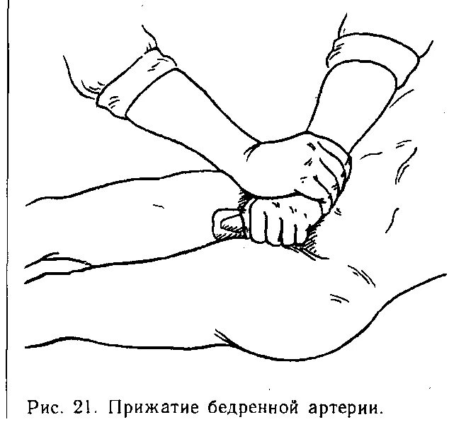 Прижатие бедренной артерии. Пальцевое прижатие бедренгой артерий. Пальцевое прижатие бедренной артерии выполняется. Прижатие бедренной артерии пальцевое прижатие.