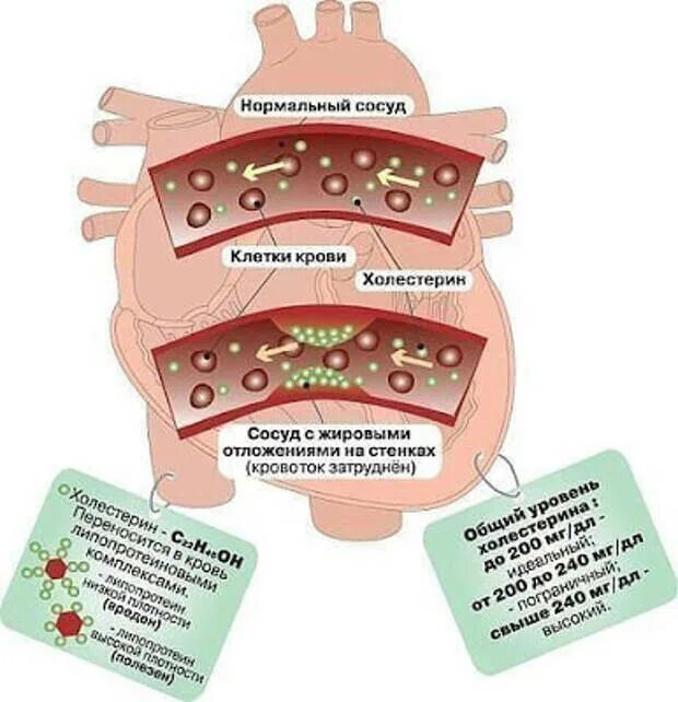 Холестерин. Холестерин в крови. Очищение сосудов холестеринa. Сосуды крови холестерин.