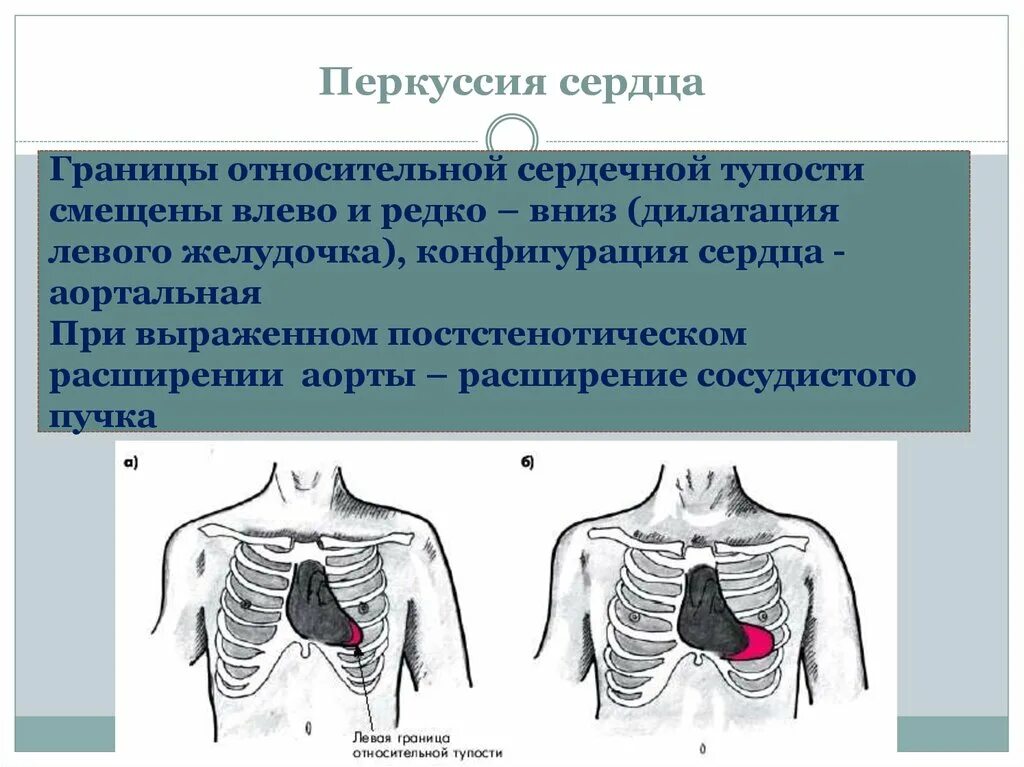 Конфигурация сердца пропедевтика внутренних болезней. Перкуссия сердца точки перкуссии. Перкуссия сердца пропедевтика. Относительная тупость сердца пропедевтика.