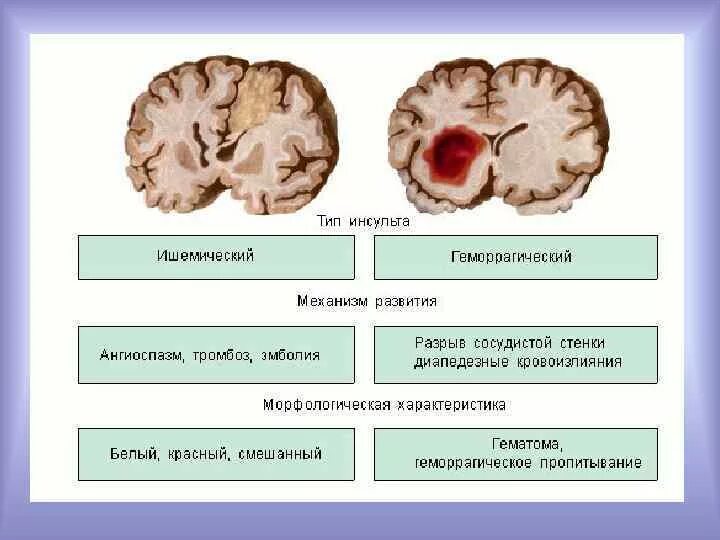 Типы ишемического инсульта. Ишемический инсульт в коре головного мозга. Ишемический инсульт мозга патанатомия. Виды инсультов головного мозга геморрагический и ишемический.