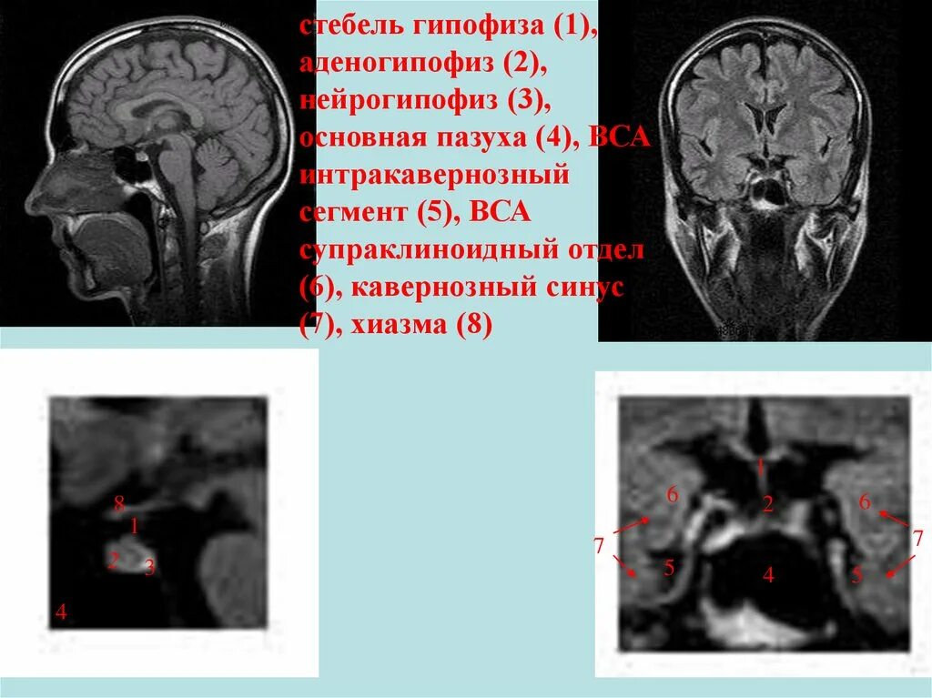 Основная пазуха гипофиза. Зрительный нерв поля зрения. Опухоли гипофиза и гипоталамуса. Строение гипоталамуса структура. Гипофиз это железа.