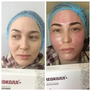 Неоколл веки хс