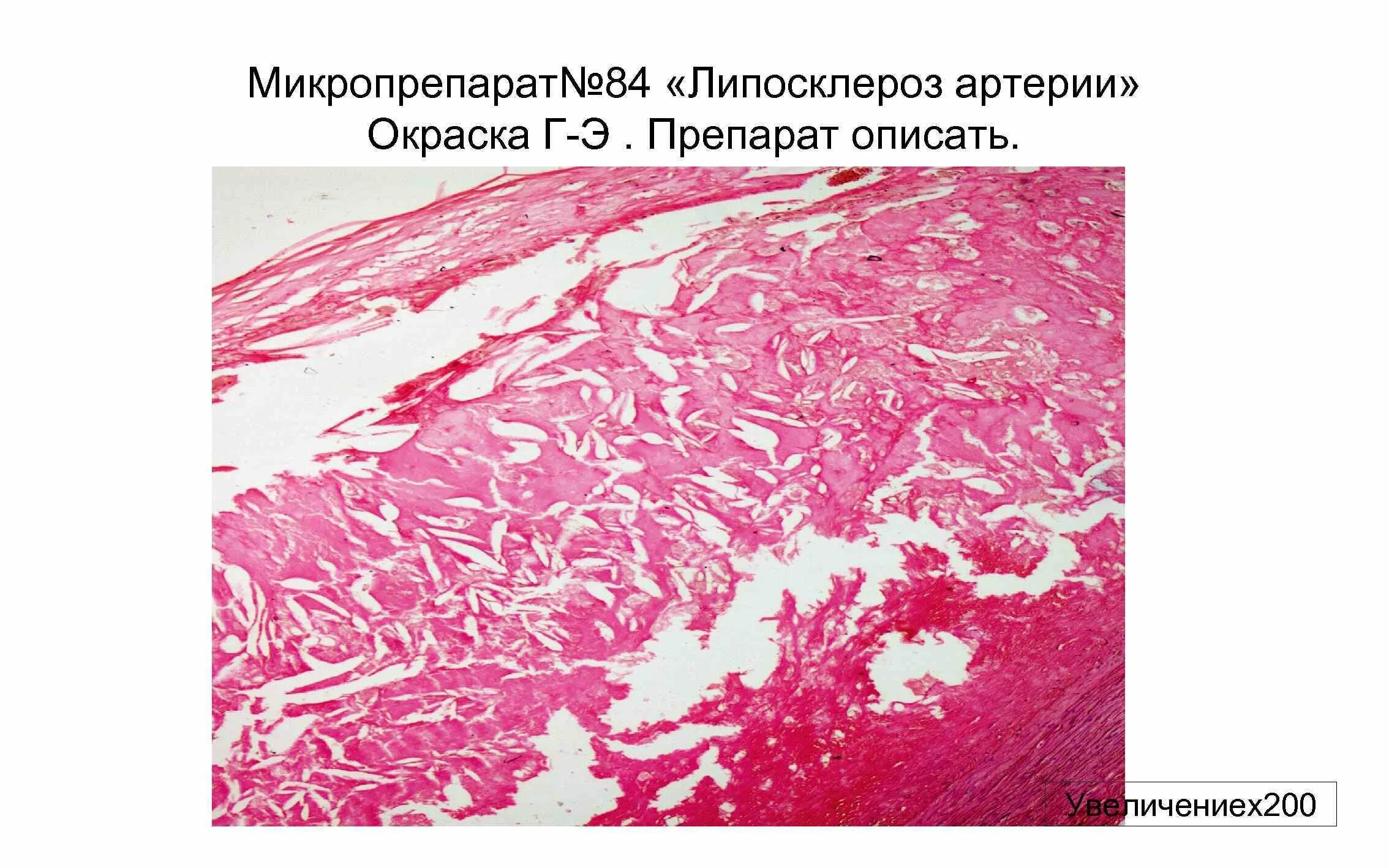 Атеросклероз аорты стадии. Атероматоз аорты микропрепарат. геморрагический инфаркт легкого микропрепарат. геморрагический инфаркт легкого микропрепарат описание. патоморфология атеросклероза.