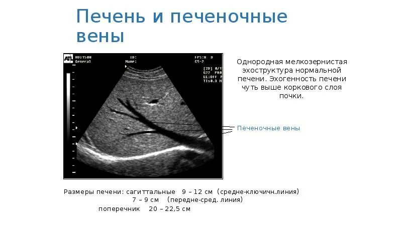 Расширенные вены печени. Расширение печеночных вен на УЗИ. Параумбиликальная Вена на УЗИ. Эхоструктура печени однородная. Расширение печеночной вены на УЗИ.