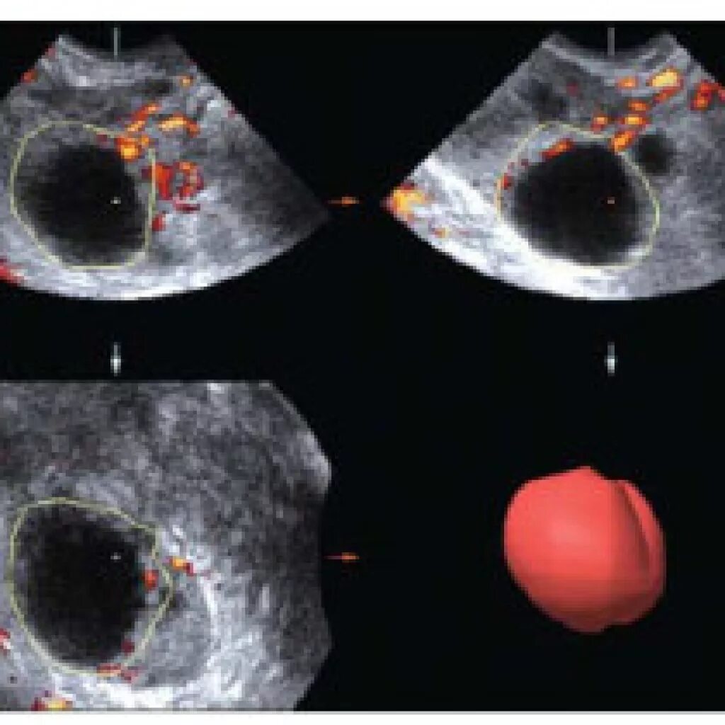 Образование округлое в яичнике. Анэхогенное образование в яичнике киста. Киста яичника киста желтого тела. Киста желтое тело анэхогенное образование. Функциональная киста яичника на УЗИ.