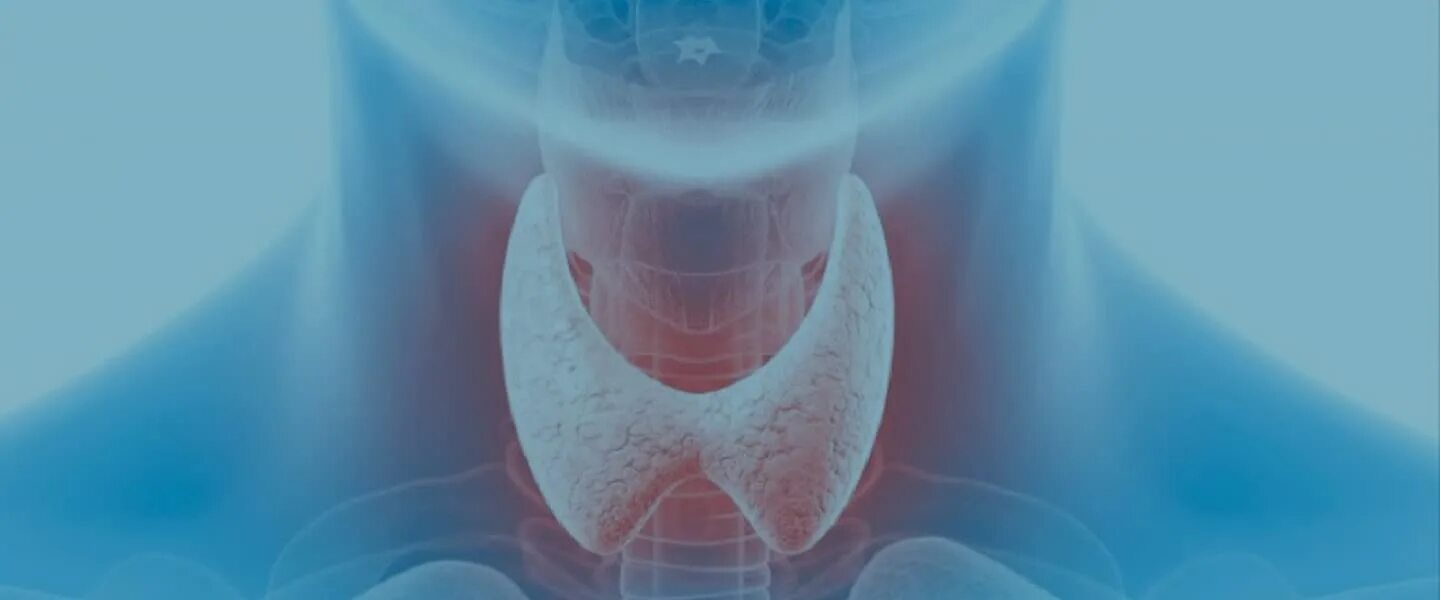 Болезнь Грейвса щитовидная железа. Диффузный токсический зоб( болезнь Грейвса-базедова). Увеличенная щитовидка фото. Зоб ахан