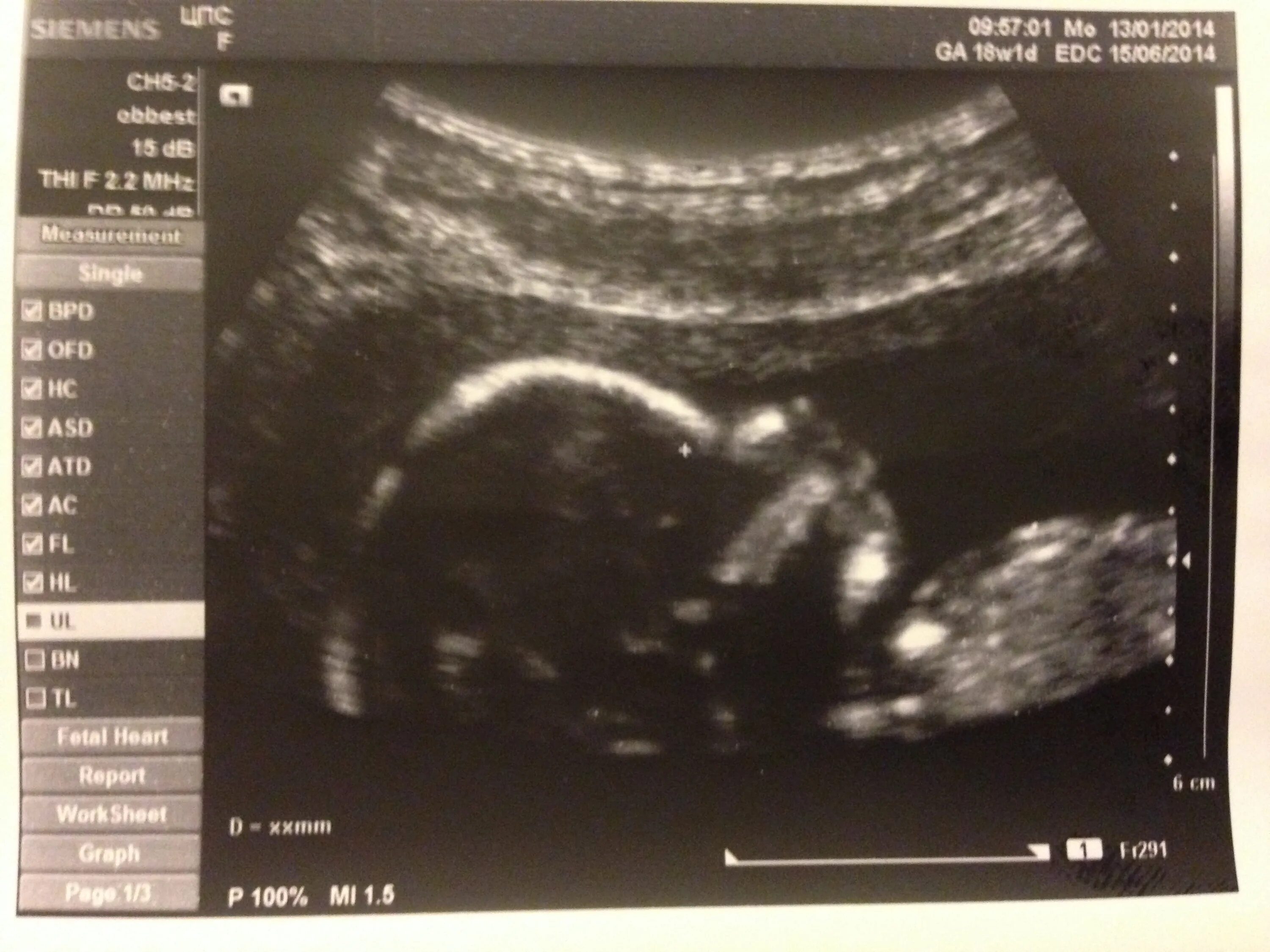 Узи 11 недель 2 дня. Первое узи после переноса эмбрионов. Узи 2м г кстово. Узи два дня подряд. Второй скрининг.