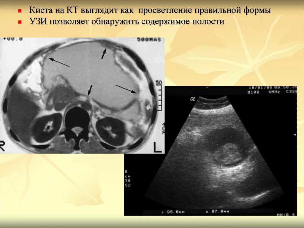 Киста печени мрт. Киста печени НАСКТ.