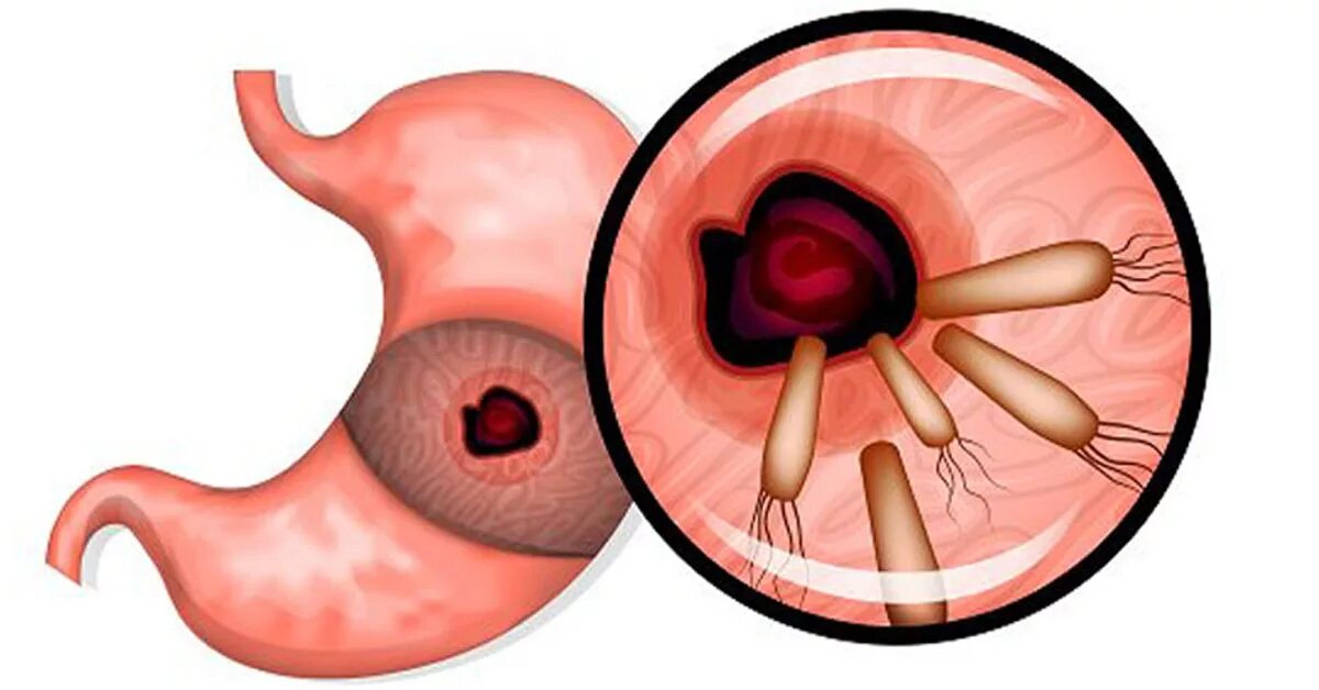 Хеликобактер пилори язвенная болезнь. Язва желудка хеликобактер пилори. Helicobacter pylori язвенная болезнь. Гастрит, язва хеликобактер пилори.