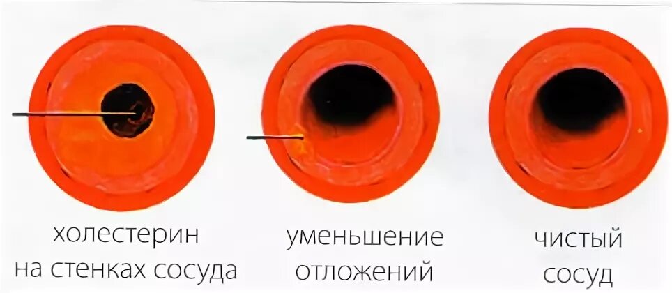 Разъедание стенок сосудов 7 букв сканворд. Разъедание стенок сосудов 7 букв сканворд. Атеросклеротические изменения в артерии. Разъедание стенки сосуда. Аррозивные кровотечения.
