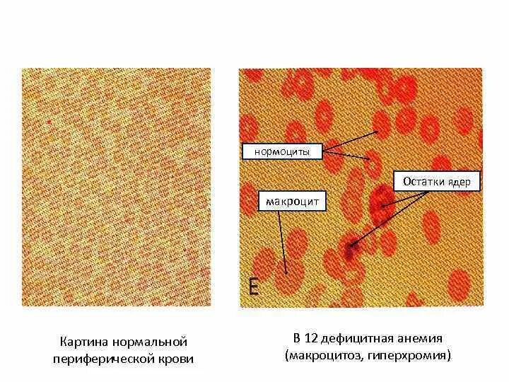 Пониженные макроциты. Макроцитоз гиперхромия анемия. Нормальная картина периферической крови. В12 дефицитная анемия картина периферической крови. Картина крови при в12 дефицитной анемии.