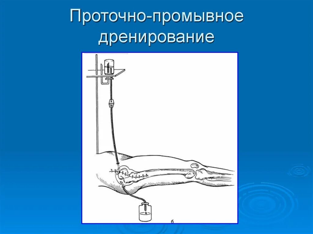 Дренирование гнойны ран. Дренирование проточно промывное дренирование. Дренирование остеомиелита. Проточно-аспирационное дренирование. Проточно промывное дренирование плевральной полости.