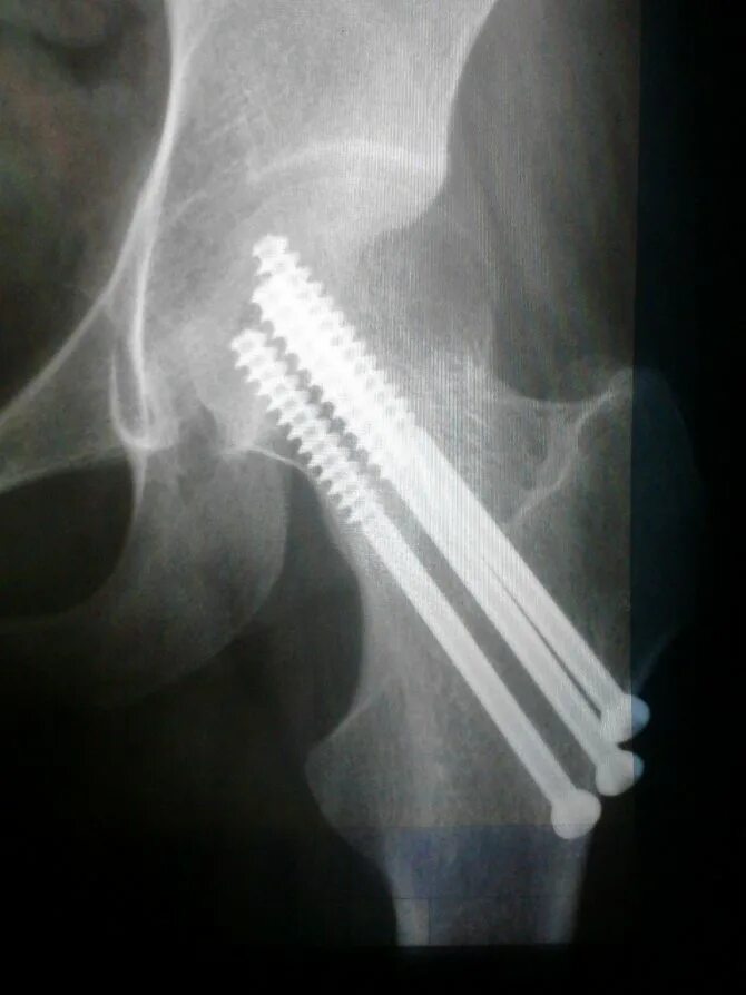 закрытый оскольчатый чрезвертельный перелом бедра. чрезвертельный перелом шейки бедра. чрезвертельный перелом перелом правого бедра со смещением отломков.