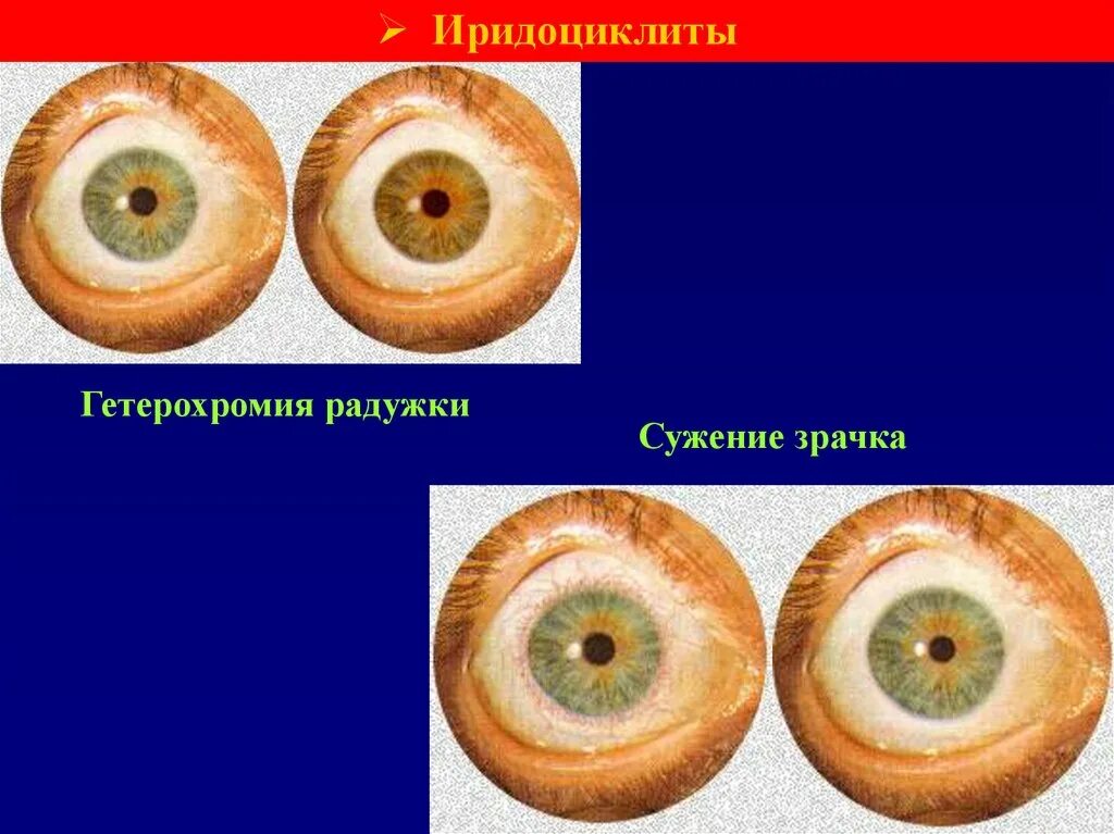 Иридоциклиты презентация. Гетерохромный иридоциклит.