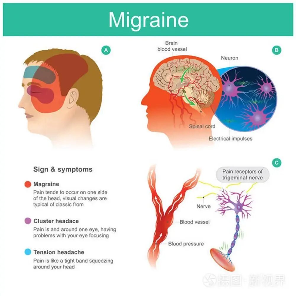 Головная боль сосуды головы. Мигрень. Расширение сосудов при мигрени. Мигрень и сосуды головного мозга. Мигрень картинки.