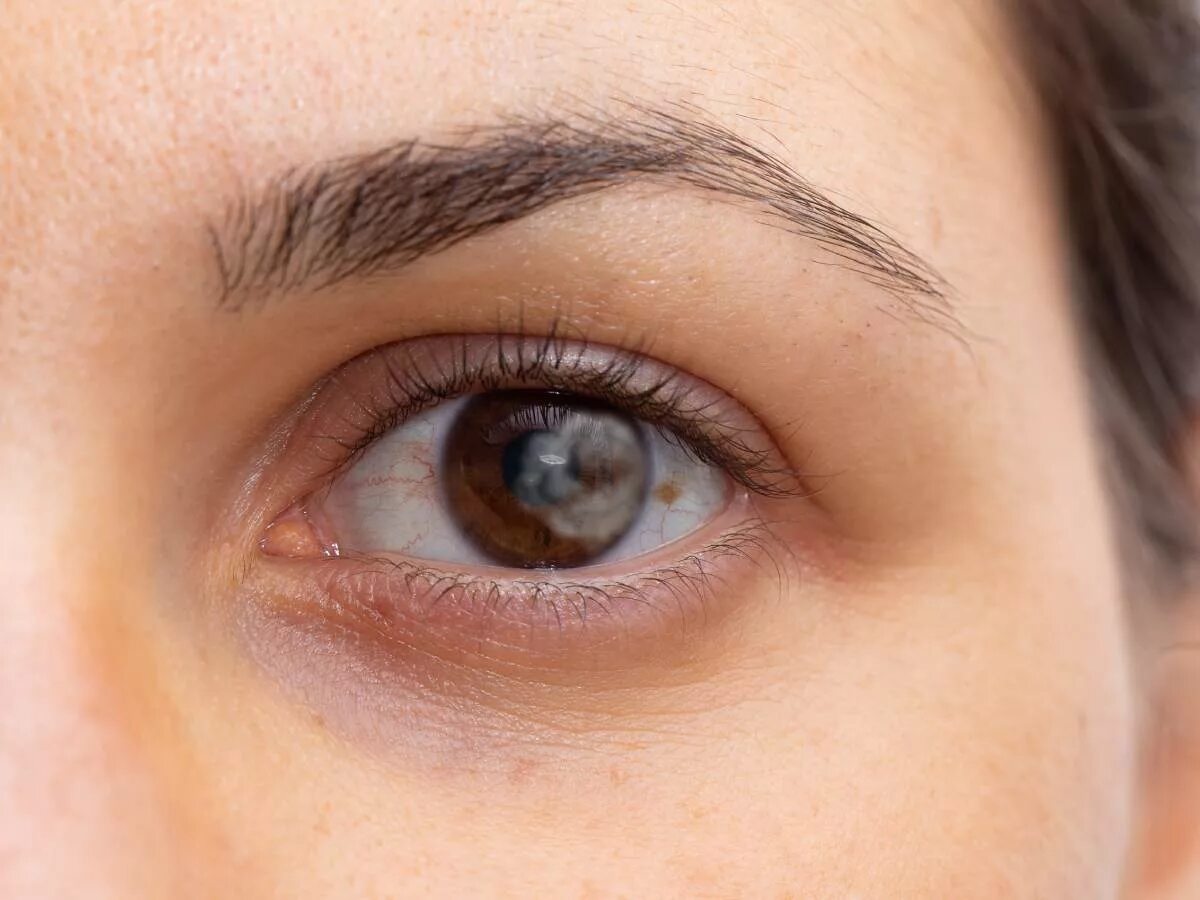 на глазах белка темные пятна