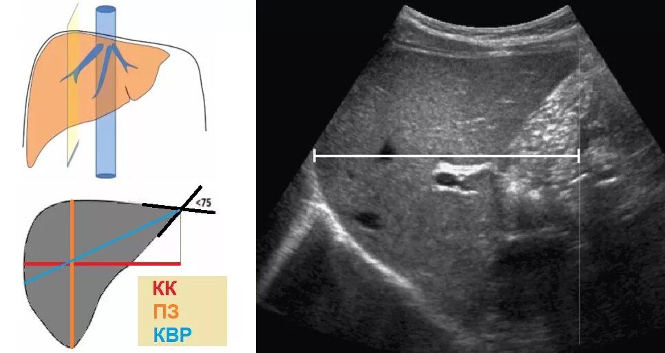 Ккр правой доли печени. Нормальные Размеры долей печени на УЗИ. Размеры левой доли печени в норме у взрослых на УЗИ. Измерение правой доли печени на УЗИ.