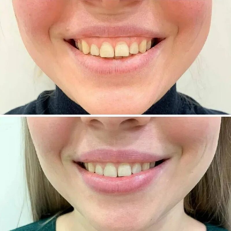 Как убрать десневую улыбку. Десневая улыбка коррекция как делают. Блейк лайвли зубы до и после. Десневая улыбка уздечка. Десневая улыбка до и после.