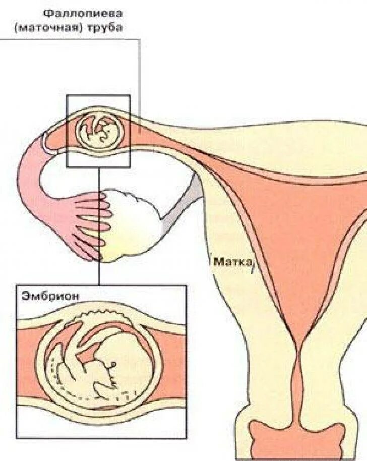 Видео где забеременеть. Эмбрион в маточной трубе. Внематочная беременность. Маточные трубы при беременности.