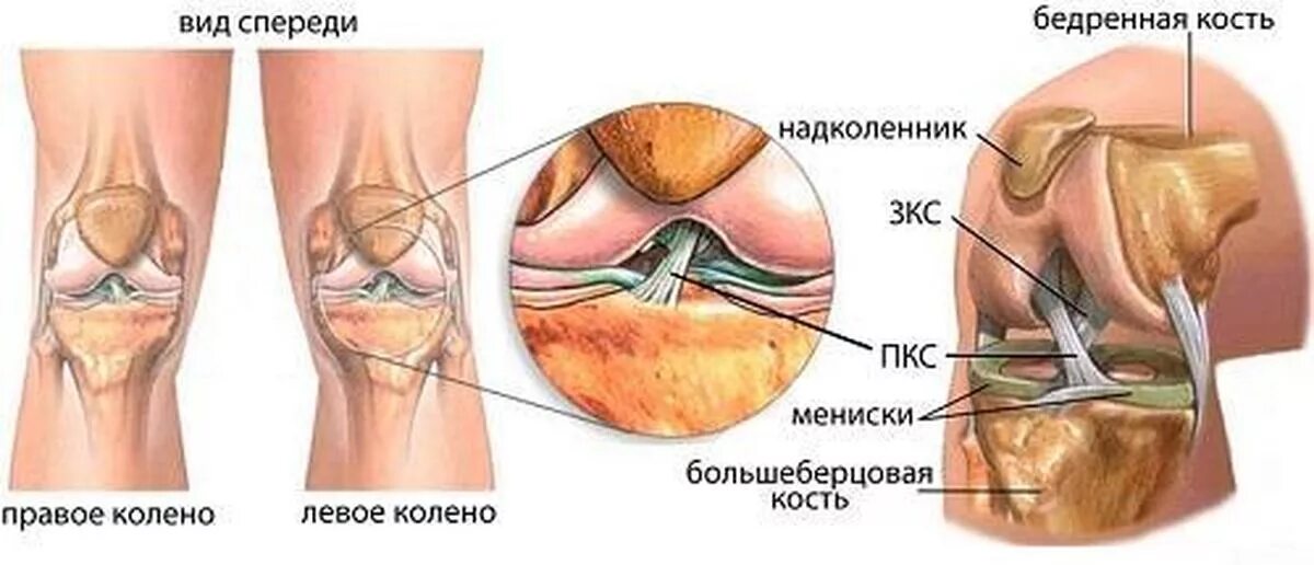 Дегенерация мениска. Крестообразные связки колена анатомия. Анатомия связок мениска коленного сустава. Передняя крестообразная связка колена. Связки коленного сустава анатомия.