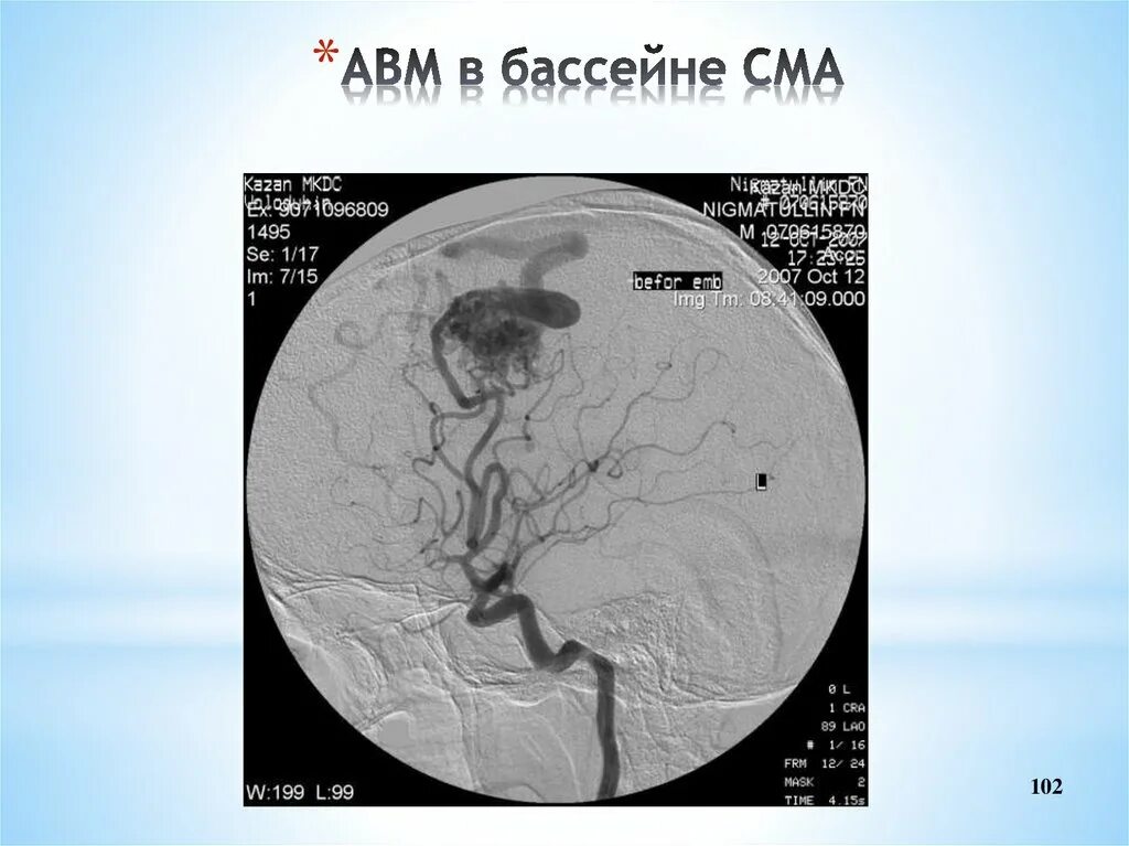 Левая средняя мозговая артерия инсульт. Бассейн средней мозговой артерии. Геморрагический инсульт в бассейне средней мозговой артерии. Инсульт в бассейне средней мозговой артерии клиника. Инсульт в бассейне СМА.