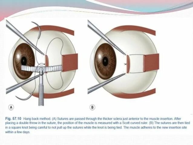 Hang back. Strabismus Eyes.