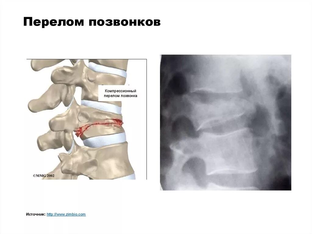 Компрессионный перелом позвоночника степени рентген. Компрессионный перелом с4 с5. Клиновидный компрессионный перелом позвоночника. Остеопороз компрессионный перелом позвоночника. Компрессионный перелом тела 1 1