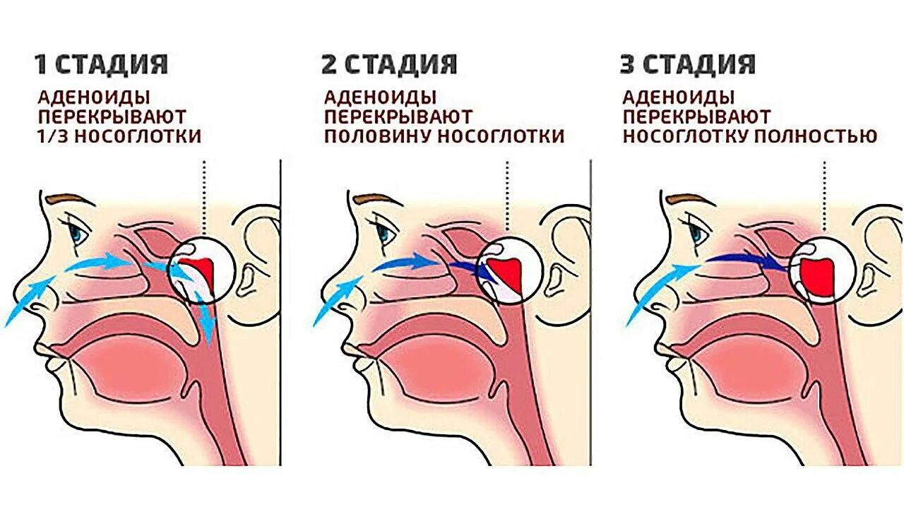 Аденоиды признаки