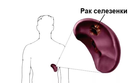 Новообразования селезенки. Спленомегалия симптомы. Болит селезенка причины симптомы