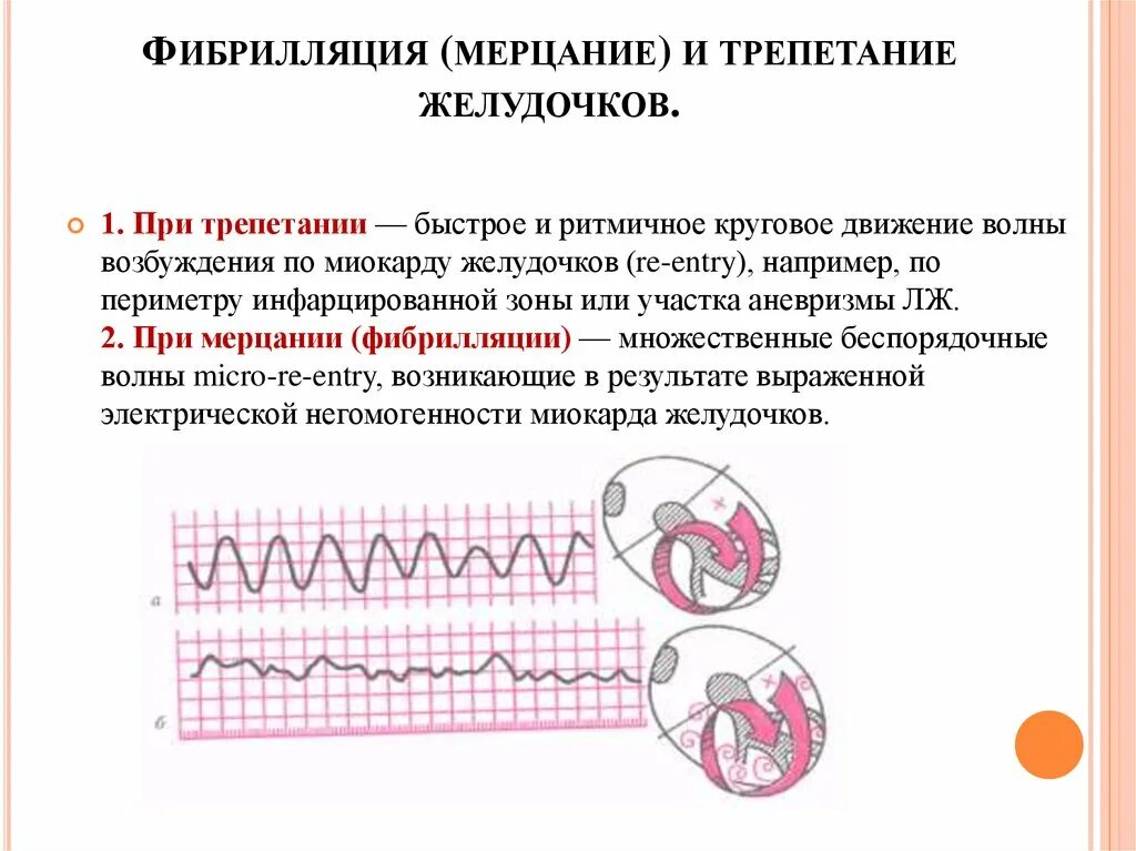 Чем отличается предсердие от желудочка. Фибрилляция желудочков на ЭКГ. Трепетание желудочков на ЭКГ. Фибрилляция предсердий и желудочков на ЭКГ. Мерцательная аритмия фибрилляция желудочко.