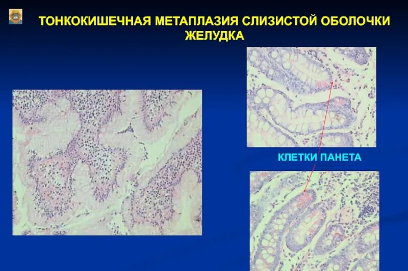 Метаплазия желудка отзывы. Кишечная метаплазия желудка гистология. Толстокишечная метаплазия гистология. Тонкокишечная метаплазия гистология. Метаплазия клеток Панета.