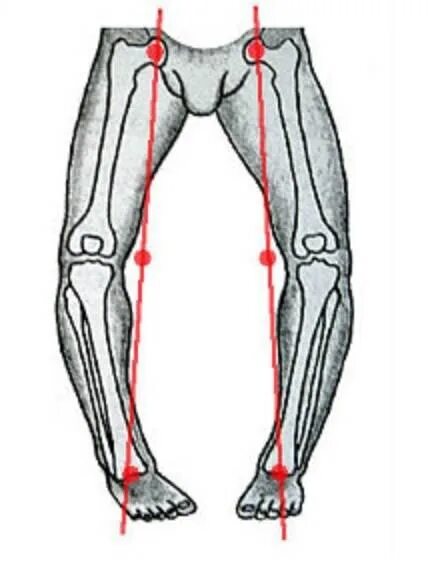 Почему ноги колесом. Варусная деформация коленных суставов. Варусная деформация конечностей. Варусная о образная деформация ног. Варусная рахитическая деформация голеней у детей.