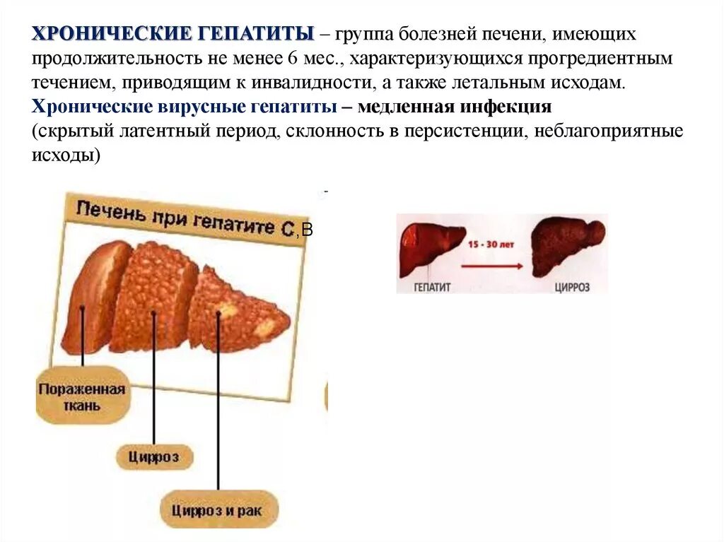 Степени поражения печени.