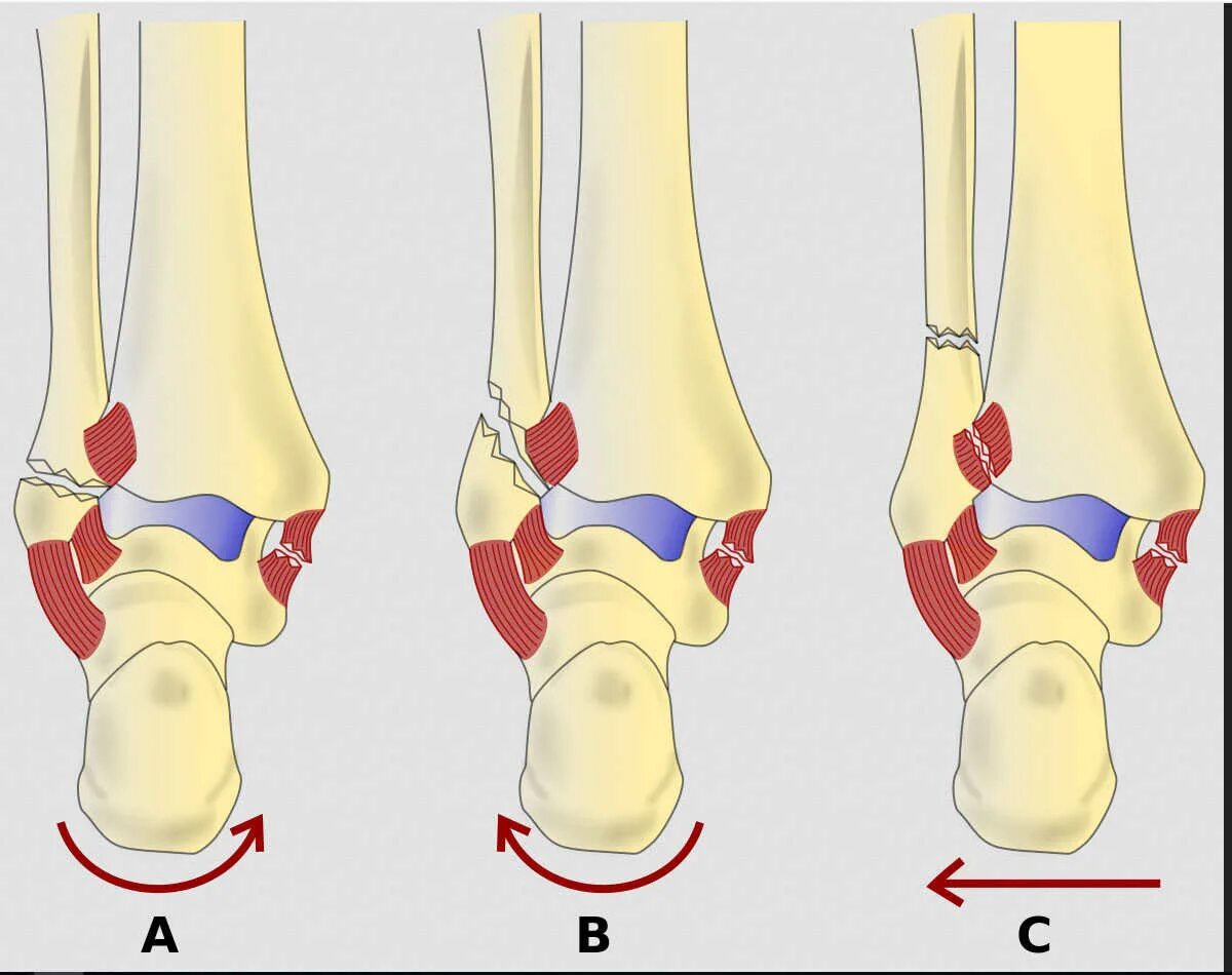 Классификация Вебера перелом лодыжек. Перелом лодыжечной кости. Перелом лодыжки синдесмоз. Классификация переломов лодыжек Lauge-Hansen. Трещина связке
